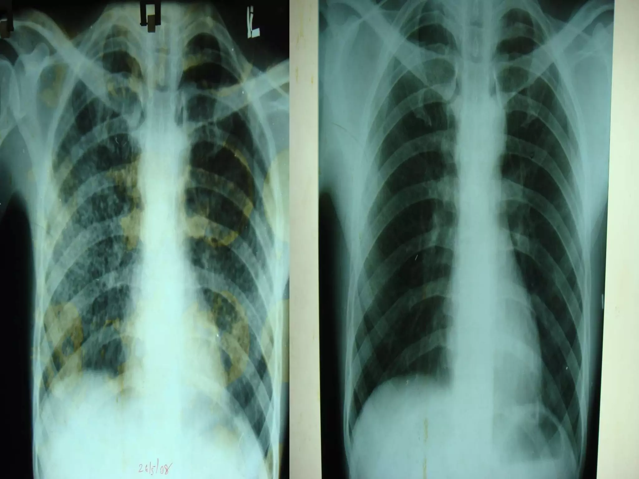 X-Ray: Miliary Tuberculosis | PPT