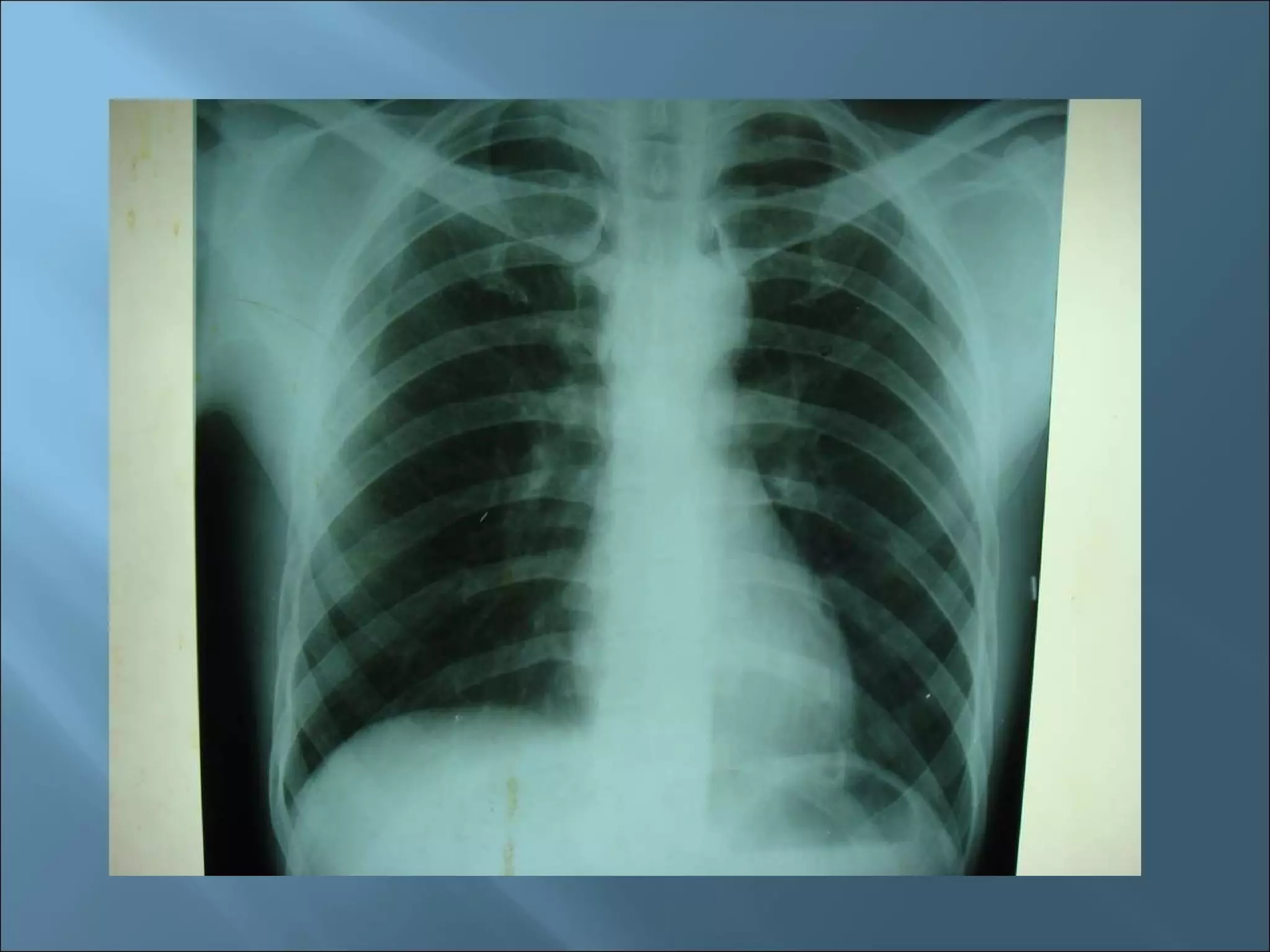 X-Ray: Miliary Tuberculosis | PPT