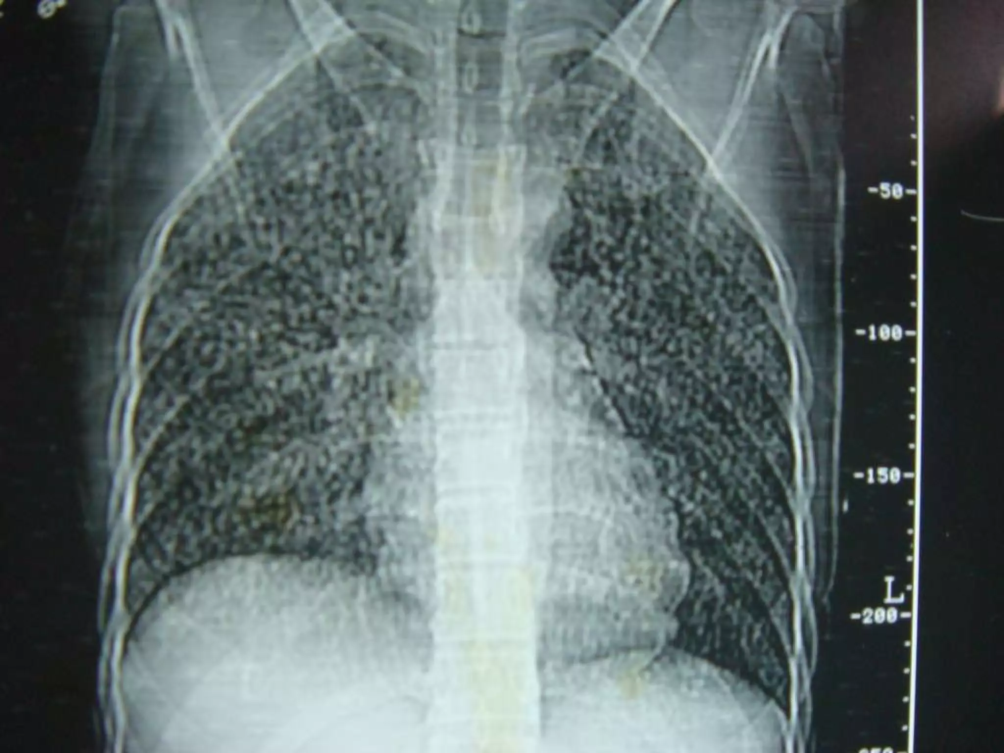 X-Ray: Miliary Tuberculosis | PPT