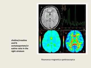 Risonanza magnetica spettroscopica 
choline/creatine 
and N-acetylaspartate/ 
cr 
eatine ratio in the 
right striatum 
 