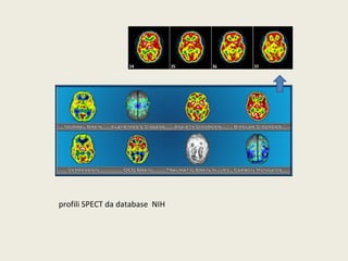 profili SPECT da database NIH 
 