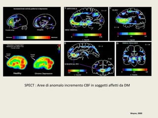 Wayne, 2000 
SPECT : Aree di anomalo incremento CBF in soggetti affetti da DM 
 