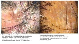 Comprehensive Case-Based Discussion on Cicatricial Alopecia Diagnosis ...