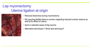 Uterine ligation at origin
Lap myomectomy
• Reduces blood loss during myomectomy
• Pts requiring fertility there is concern regarding reduced ovarian reserve as
well as its effect on uterus
• done in selected cases of big myoma
• Alternative techniques ? Shoe lace technique?
 