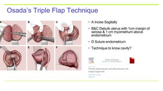 Osada’s Triple Flap Technique
• A Incise Sagitally
• B&C Debulk uterus with 1cm margin of
serosa & 1 cm myometrium above
endometrium
• D Suture endometrium
• Technique to know cavity?
 