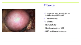 Fibroids
• A 32 yrs old lady , Having a 4 cm
Intramural fundal Fibroid .
• 2 yrs of infertility
• 2 failed IUI
• No male factor
• No other problem in USG
• HSG s/o bilateral tube sopen
 