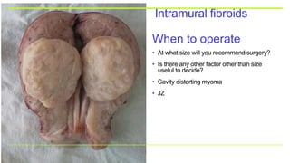 Intramural fibroids
When to operate
• At what size will you recommend surgery?
• Is there any other factor other than size
useful to decide?
• Cavity distorting myoma
• JZ
 