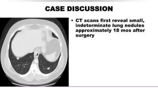 CASE DISCUSSION
 CT scans first reveal small,
indeterminate lung nodules
approximately 18 mos after
surgery
 