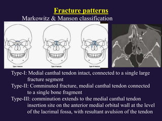 panfacial fractures- anatomy, clinical features, radiology.pptx