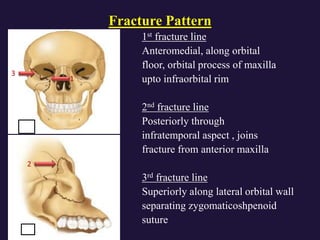 panfacial fractures- anatomy, clinical features, radiology.pptx