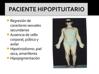  Regresión de
caracteres sexuales
secundarios
 Ausencia de vello
corporal, púbico y
axilar
 Hipotiroidismo: piel
seca, amarillenta
 Hipopigmentación
 