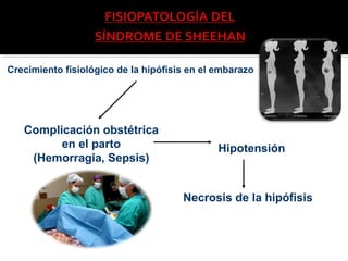 Crecimiento fisiológico de la hipófisis en el embarazo
Complicación obstétrica
en el parto
(Hemorragia, Sepsis)
Hipotensión
Necrosis de la hipófisis
 