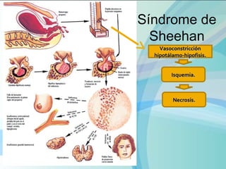 VasoconstricciónVasoconstricción
hipotálamo-hipofisis.hipotálamo-hipofisis.
Isquemia.Isquemia.
Necrosis.Necrosis.
Síndrome de
Sheehan
 