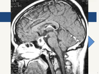 Hipopituitarismo adquirido

Hipófisitis linfocítica
• Mujer en postparto
• Cefalea, defectos visuales, ESR elevado
• Hiperprolactinemia
• Masa en RM
Peter J. Snyder, cols. Causes of hypopituitarism. Uptodate. 2013

9

 