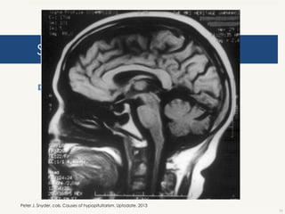 Síndrome de silla turca vacía
 Congénita o adquirida después de cirugía.

Peter J. Snyder, cols. Causes of hypopituitarism. Uptodate. 2013
11

 