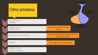 • Procesos infecciosos
• Sarcoidosis
• Hipofisitis linfocitaria
• Hemocromatosis
• Aterosclerótico de la carótida interna
• Yatrógenas
• Metástasis de Cáncer
• Síndrome de la silla turca
Depósito de hierro en las
células
Aneurisma dilatada-hipopituitarismo
por compresión
Quirúrgico, La radioterapia
 