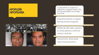 La piel pierde su turgencia y
adquiere un aspecto céreo y frío,
la cara está pálida con arrugas
muy finas
El paciente presenta un aspecto
prematuramente envejecido.
Pérdida del vello axilar y pubiano
en ambos géneros y atrofia de
mamas o testículos
Psíquicamente, desde apatía
hasta síntomas psicóticos.
 