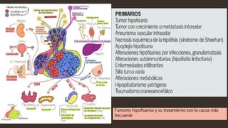 Tumores hipofisarios y su tratamiento son la causa más
frecuente
 