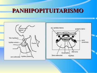 PANHIPOPITUITARISMO 