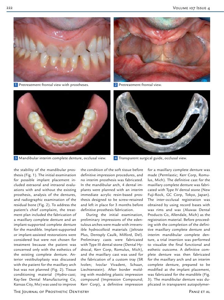 A technique for immediate occlusal implant loading of a completely