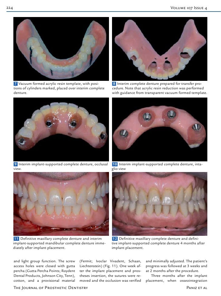 A technique for immediate occlusal implant loading of a completely
