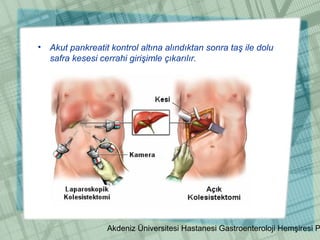 Akdeniz Üniversitesi Hastanesi Gastroenteroloji Hemşiresi P
• Akut pankreatit kontrol altına alındıktan sonra taş ile dolu
safra kesesi cerrahi girişimle çıkarılır.
 