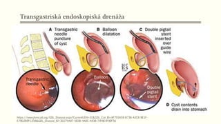 Transgastriskā endoskopiskā drenāža
https://www.jhmicall.org/GDL_Disease.aspx?CurrentUDV=31&GDL_Cat_ID=AF793A59-B736-42CB-9E1F-
E79D2B9FC358&GDL_Disease_ID=3D279407-583B-4A0C-A93B-74F8E4F90F56
 