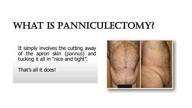 Panniculectomy By Dr tim panniculectomy-by-dr-tim