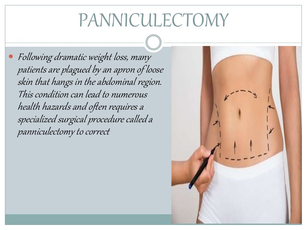 PANNICULECTOMY IN ATLANTA, GA