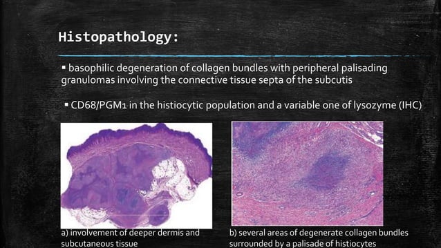 Panniculitis.rooks.dermatology | PPTX | Skin and Dermatology | Diseases ...