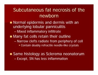 Subcutaneous fat necrosis of theSubcutaneous fat necrosis of the
bbnewbornnewborn
Normal epidermis and dermis with anNormal epidermis and dermis with anNormal epidermis and dermis with anNormal epidermis and dermis with an
underlying lobular panniculitisunderlying lobular panniculitis
–– Mixed inflammatory infiltrateMixed inflammatory infiltrateyy
Many fat cells retain their outlineMany fat cells retain their outline
–– Narrow clefts radiate from periphery of cellNarrow clefts radiate from periphery of cellNarrow clefts radiate from periphery of cellNarrow clefts radiate from periphery of cell
Contain doubly refractile needleContain doubly refractile needle--like crystalslike crystals
Same histology as Sclerema neonatorumSame histology as Sclerema neonatorum
–– Except, SN has less inflammationExcept, SN has less inflammation
 