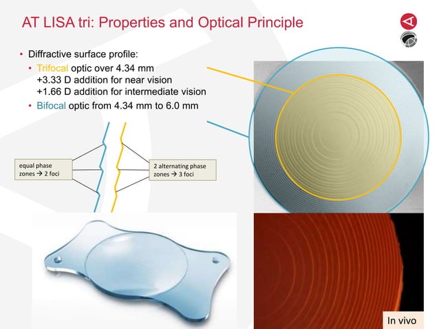 New Versus Former-Generation Diffractive Trifocal Intraocular Lens ...