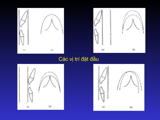 Các vị trí đặt đầu
 
