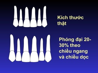 Kích thước
thật
Phóng đại 20-
30% theo
chiều ngang
và chiều dọc
 