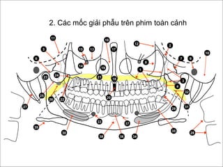 24
23
28
27
18
17
19
14
1315
20
8
10
97
29
37
38
33
30
39
3
5
11
21
6
1
12
16
31
32
25
4
26
34
35
36
22
2
2. Các mốc giải phẫu trên phim toàn cảnh
 