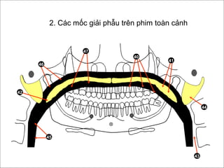 41
40
47
45
46
43
44
42
2. Các mốc giải phẫu trên phim toàn cảnh
 