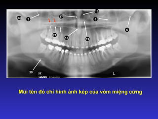 Mũi tên đỏ chỉ hình ảnh kép của vòm miệng cứng
2 8
19
17
18
6
16
21
23
39
 