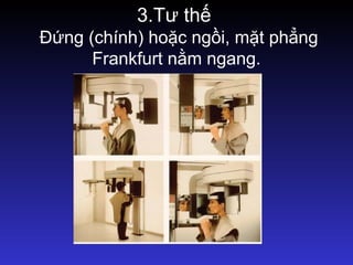 3.Tư thế
Đứng (chính) hoặc ngồi, mặt phẳng
Frankfurt nằm ngang.
 