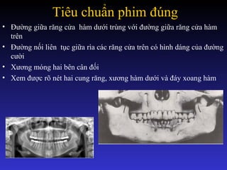 Tiêu chuẩn phim đúng
• Đường giữa răng cửa hàm dưới trùng với đường giữa răng cửa hàm
trên
• Đường nối liên tục giữa rìa các răng cửa trên có hình dáng của đường
cười
• Xương móng hai bên cân đối
• Xem được rõ nét hai cung răng, xương hàm dưới và đáy xoang hàm
 