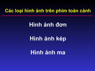 Các loại hình ảnh trên phim toàn cảnh
Hình ảnh đơn
Hình ảnh kép
Hình ảnh ma
 