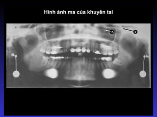Hình ảnh ma của khuyên tai
15 2
 