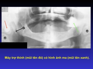 Máy trợ thính (mũi tên đỏ) có hình ảnh ma (mũi tên xanh).
27
28
28
 