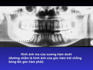 Hình ảnh ma của xương hàm dưới
(đường chấm là hình ảnh của góc hàm trái chồng
bóng lên góc hàm phải)
 