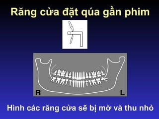 Răng cửa đặt qúa gần phim
Hình các răng cửa sẽ bị mờ và thu nhỏ
 