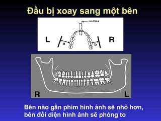 Bên nào gần phim hình ảnh sẽ nhỏ hơn,
bên đối diện hình ảnh sẽ phóng to
Đầu bị xoay sang một bên
 