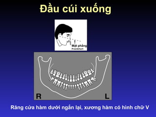 Răng cửa hàm dưới ngắn lại, xương hàm có hình chữ V
Đầu cúi xuống
Mặt phẳng
 