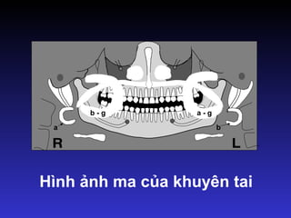 a
a - g
b
b - g
Hình ảnh ma của khuyên tai
 