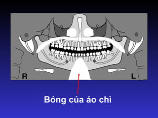 Bóng của áo chì
 
