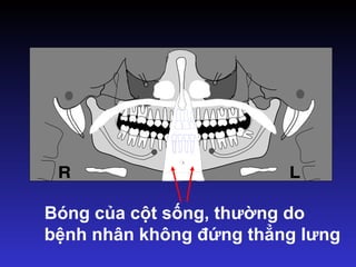 Bóng của cột sống, thường do
bệnh nhân không đứng thẳng lưng
 