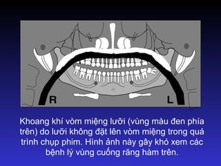 Khoang khí vòm miệng lưỡi (vùng màu đen phía
trên) do lưỡi không đặt lên vòm miệng trong quá
trình chụp phim. Hình ảnh này gây khó xem các
bệnh lý vùng cuống răng hàm trên.
 